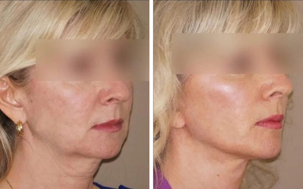 Lifting de cuello caso 2 — antes y después